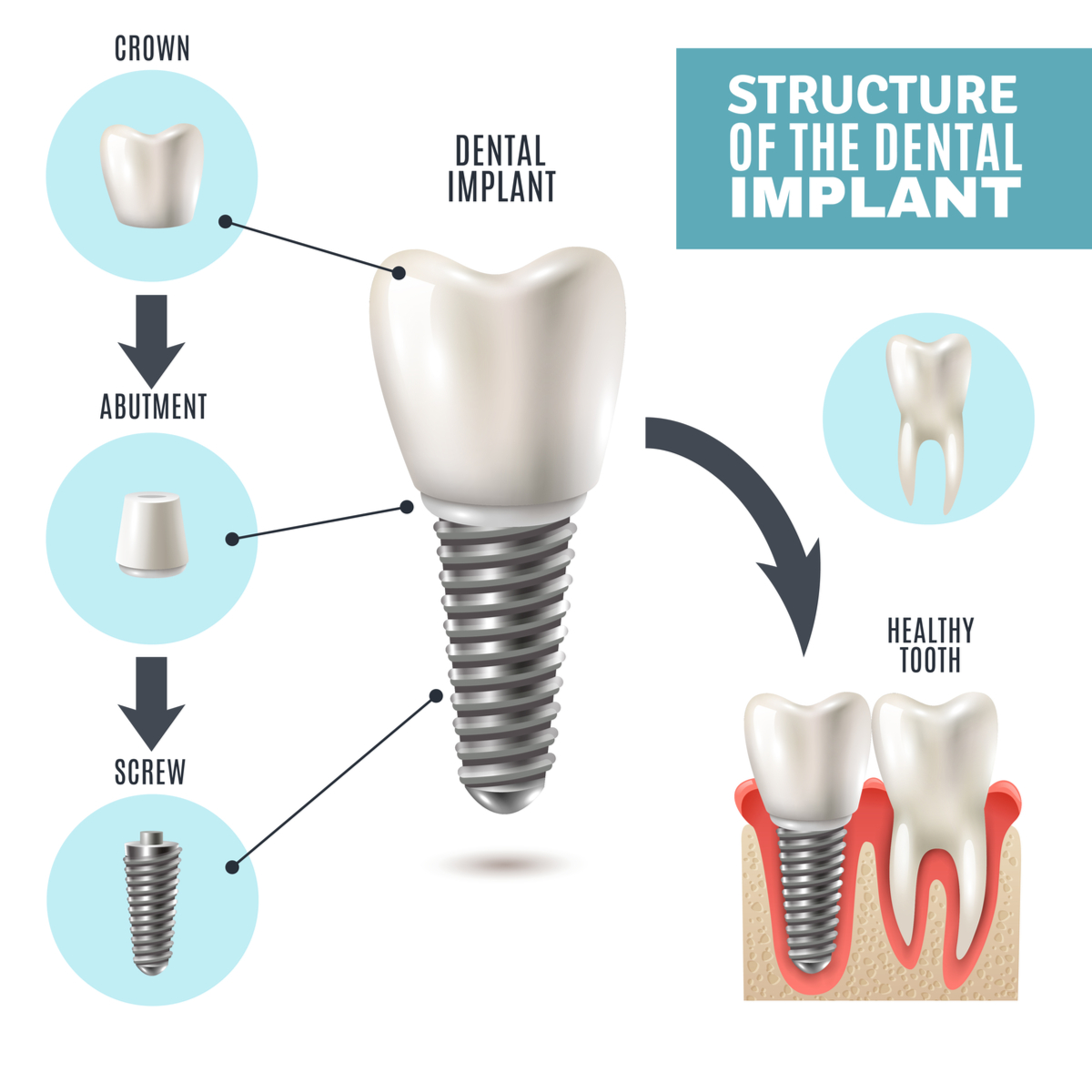 Dental Implant