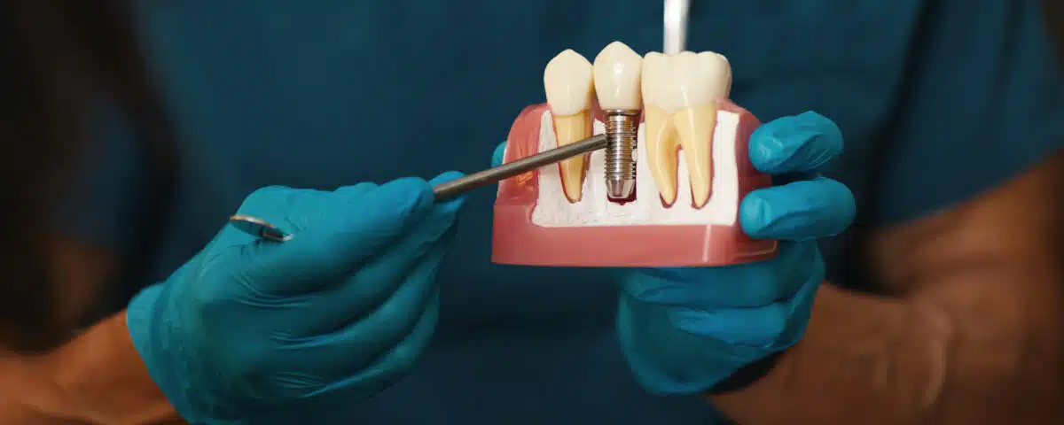 5-signs-youre-a-candidate-for-dental-implants