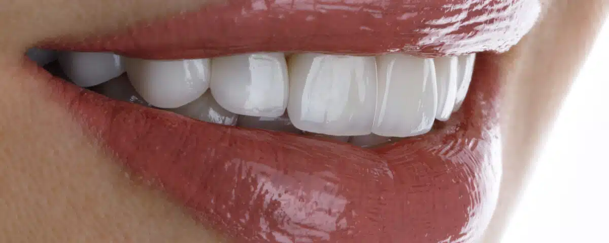 are-veneers-permanent