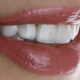 are-veneers-permanent