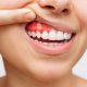 bleeding-gums-normal-or-a-sign-of-something-more