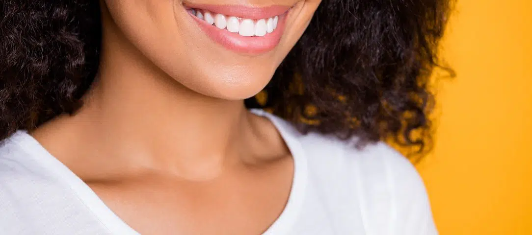 bonding-vs-veneers-whats-better