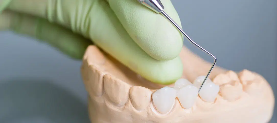 bridge-the-gap-of-missing-teeth-with-a-dental-bridge