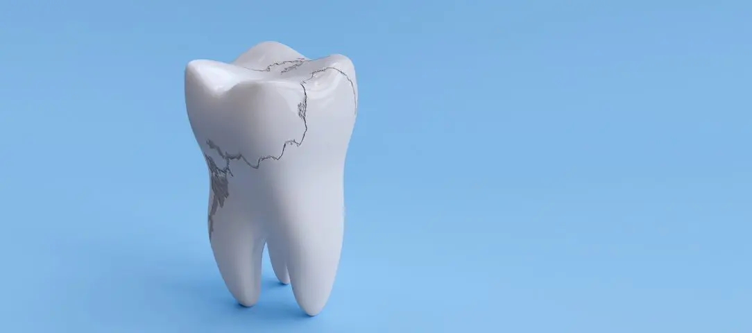 can-a-cracked-tooth-be-saved