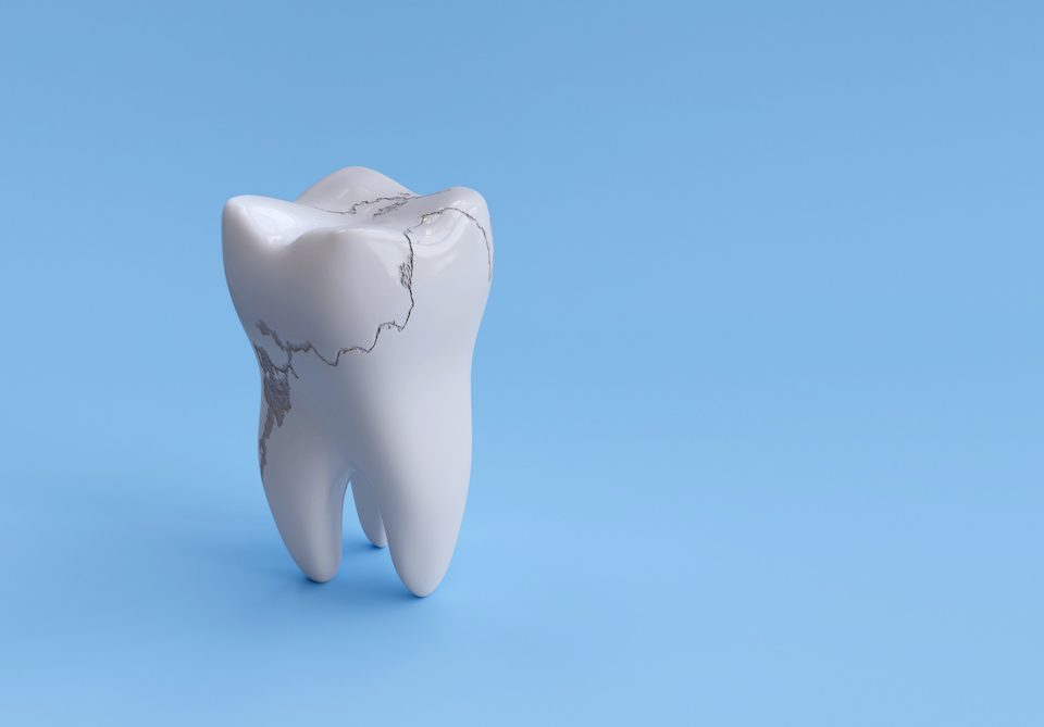 can-a-cracked-tooth-be-saved