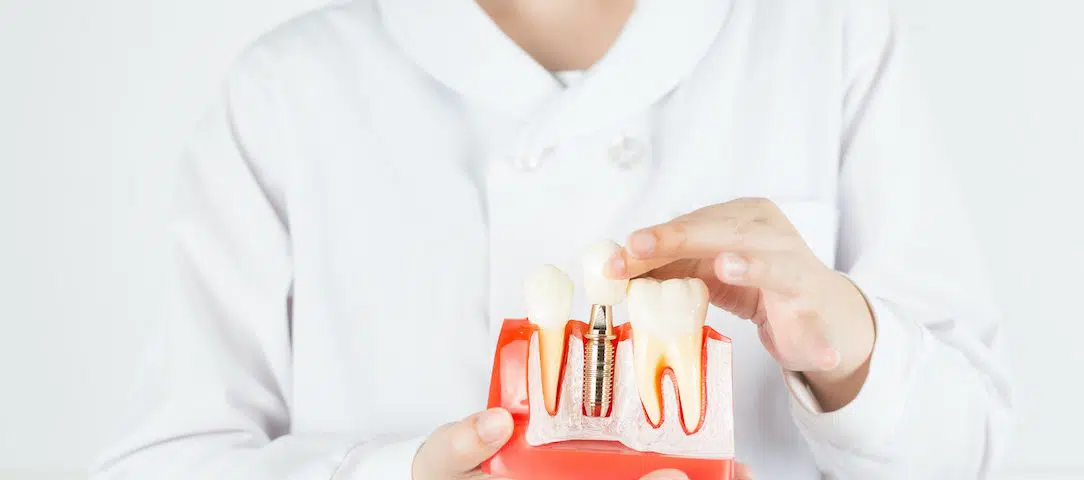 do-dental-implants-replace-missing-teeth