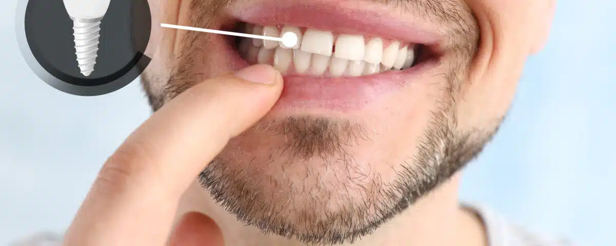 facts-about-dental-implant-recovery-process