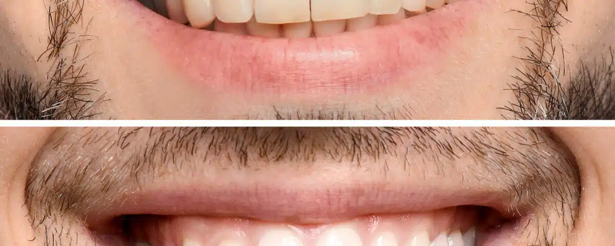 how-to-maintain-your-teeth-whitening-results