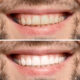 how-to-maintain-your-teeth-whitening-results
