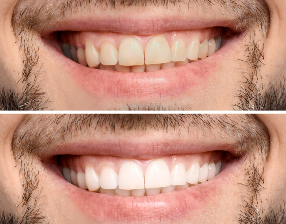 how-to-maintain-your-teeth-whitening-results