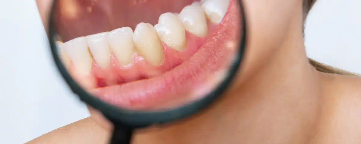 how-to-prevent-plaque-buildup