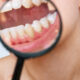 how-to-prevent-plaque-buildup