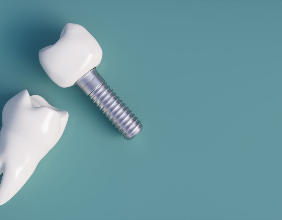 improve-your-smile-with-dental-implant-surgery