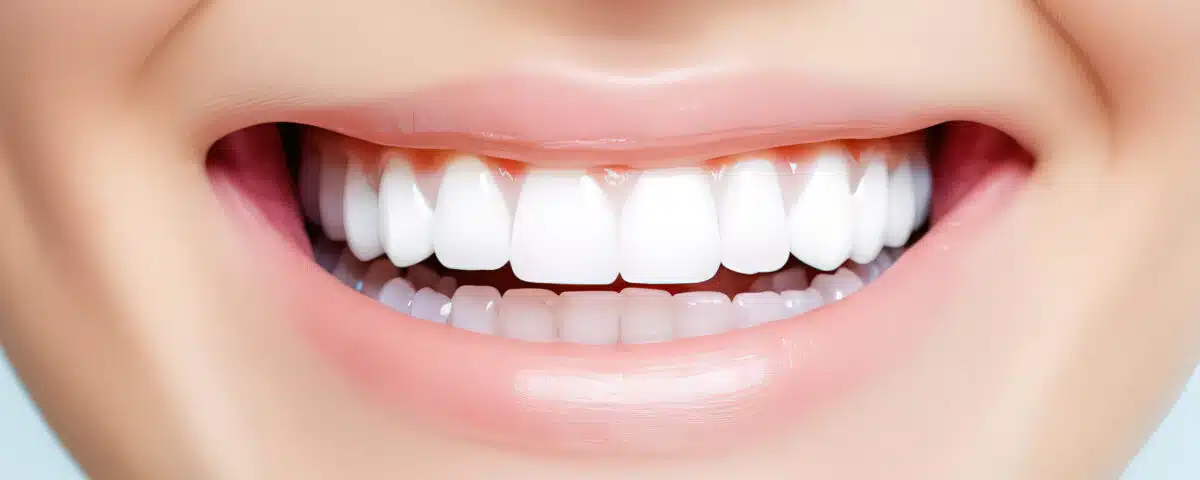 instant-smile-makeover-all-you-need-to-know-about-dental-veneers
