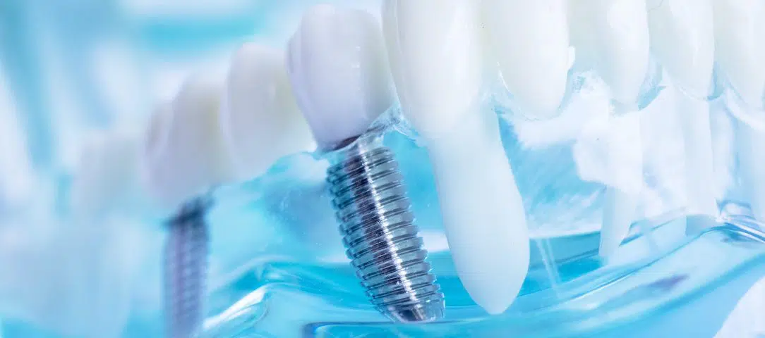 is-it-time-for-dental-implants