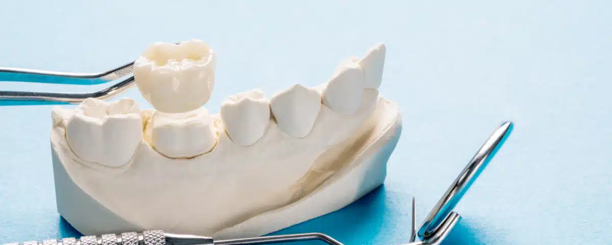 restore-your-smile-with-same-day-crowns