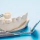 restore-your-smile-with-same-day-crowns