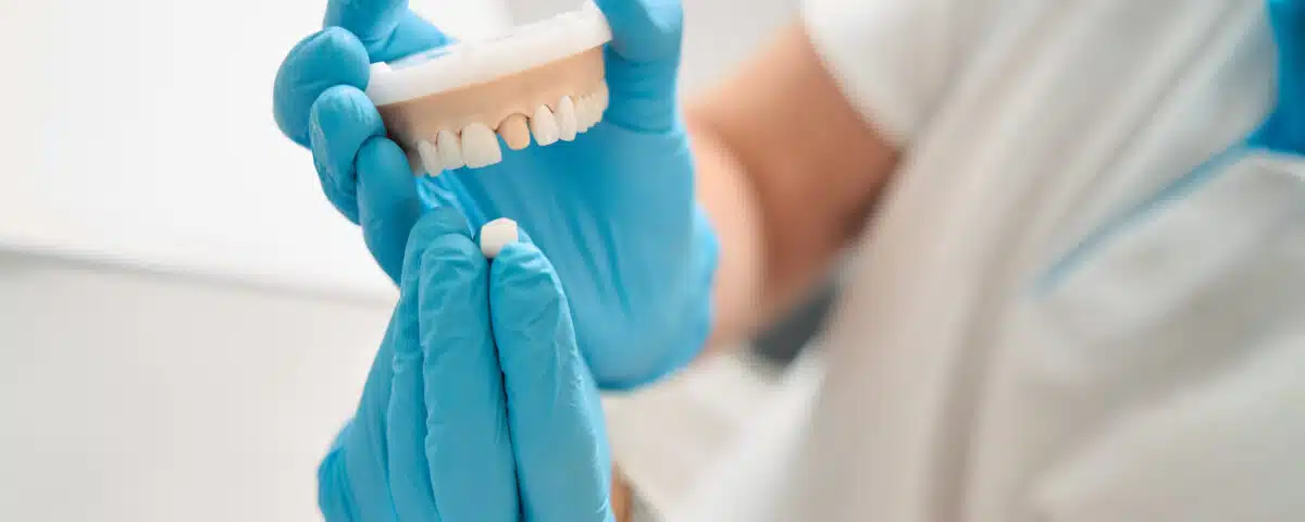 how-dental-crowns-protect-weak-or-damaged-teeth