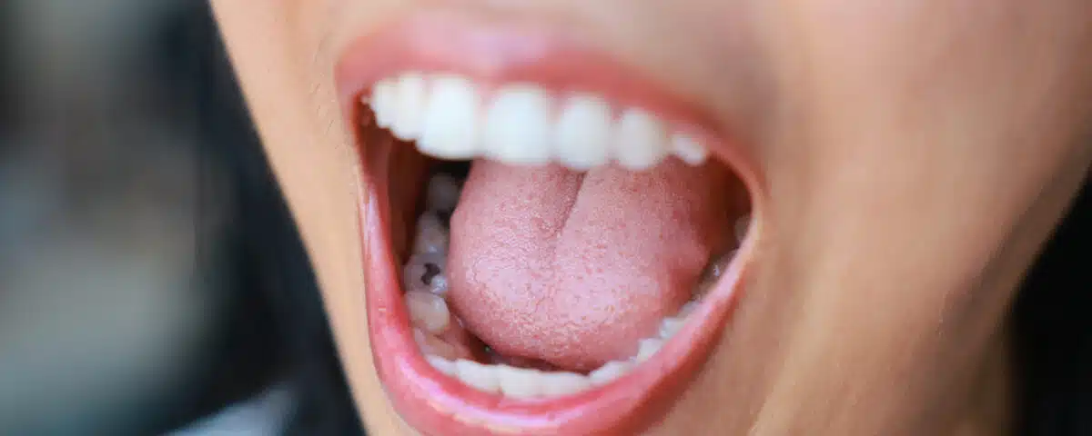 treat-tooth-decay-with-mountain-aire-dentistry
