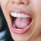treat-tooth-decay-with-mountain-aire-dentistry