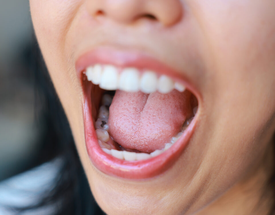 treat-tooth-decay-with-mountain-aire-dentistry