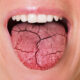 ways-to-fight-dry-mouth