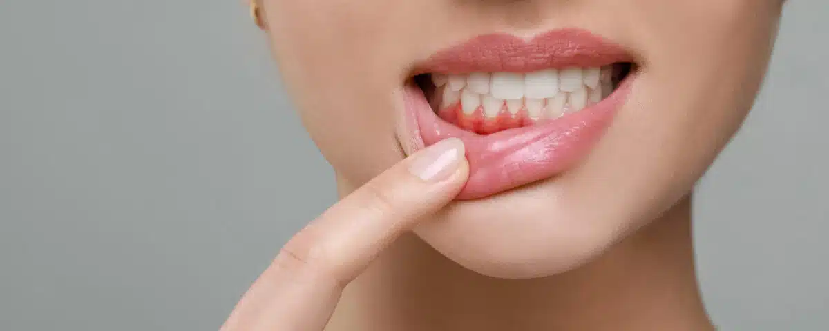 what-happens-if-you-dont-treat-gum-disease