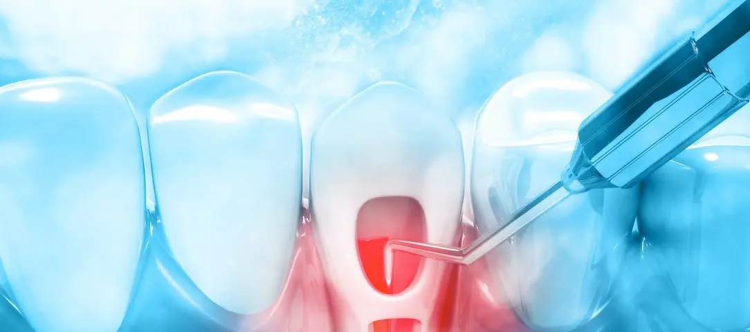 what-is-root-canal-therapy