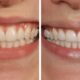 what-to-do-after-your-teeth-whitening-treatment