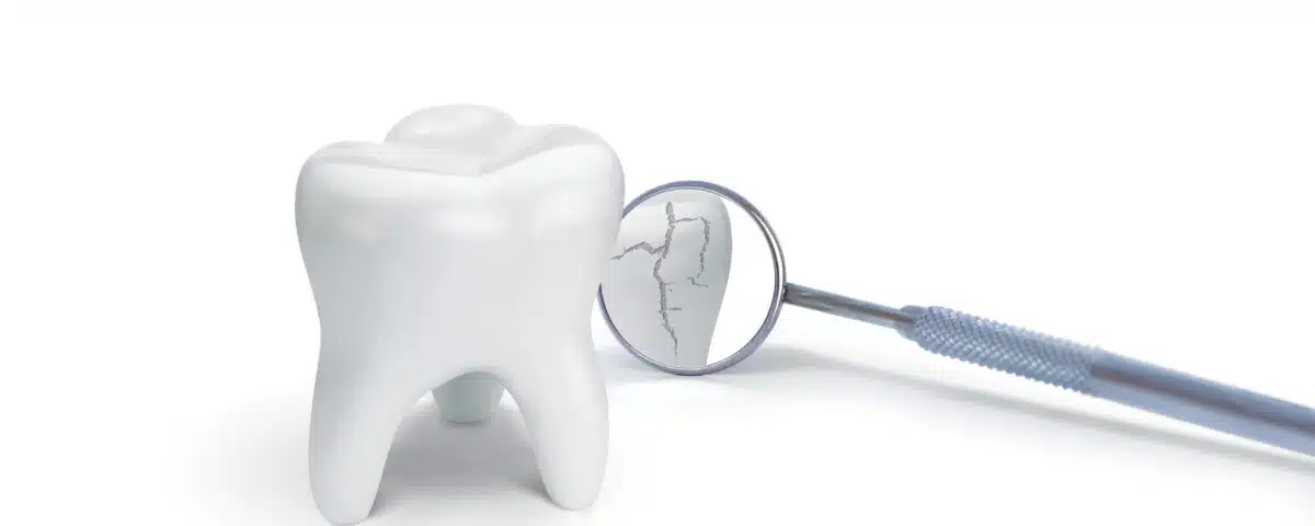 what-to-do-when-you-crack-a-tooth-expert-advice