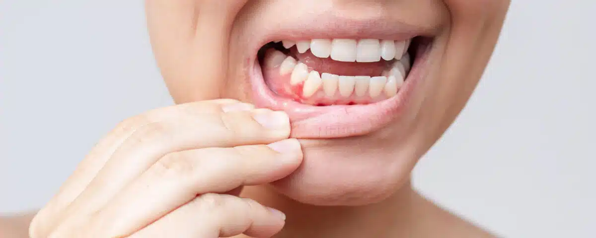 what-your-gums-are-telling-you-early-signs-of-gum-disease