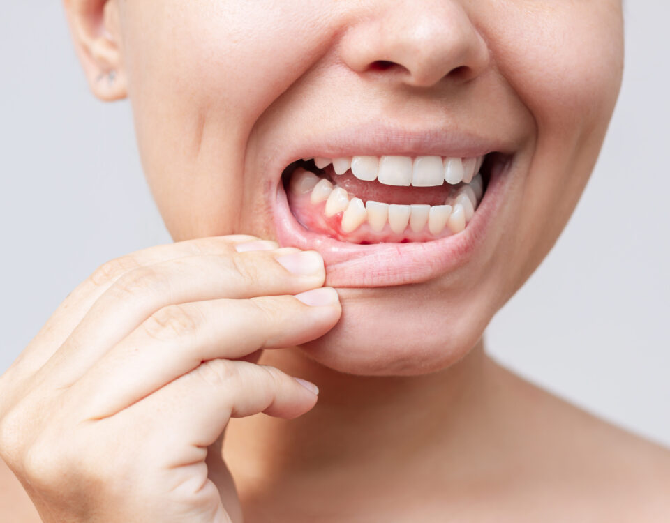 what-your-gums-are-telling-you-early-signs-of-gum-disease