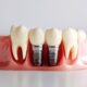 why-dental-implants-are-the-gold-standard-for-tooth-replacement