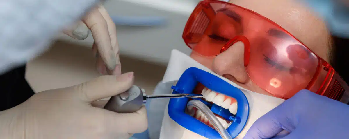 why-professional-teeth-whitening-beats-diy-kits