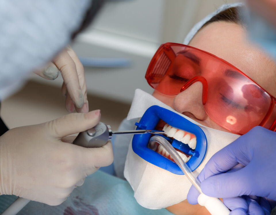 why-professional-teeth-whitening-beats-diy-kits