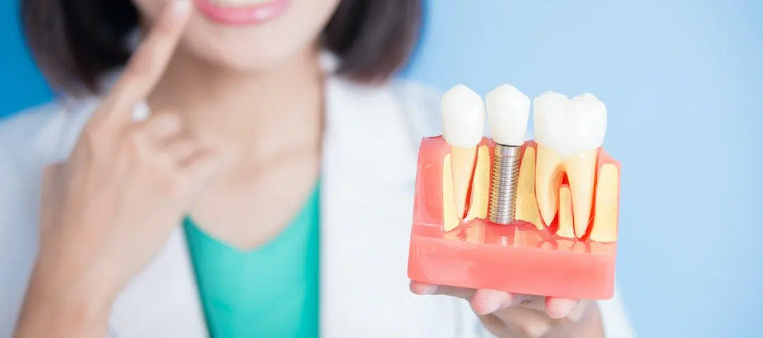 why-replacing-lost-teeth-is-important-the-benefits-of-dental-implants
