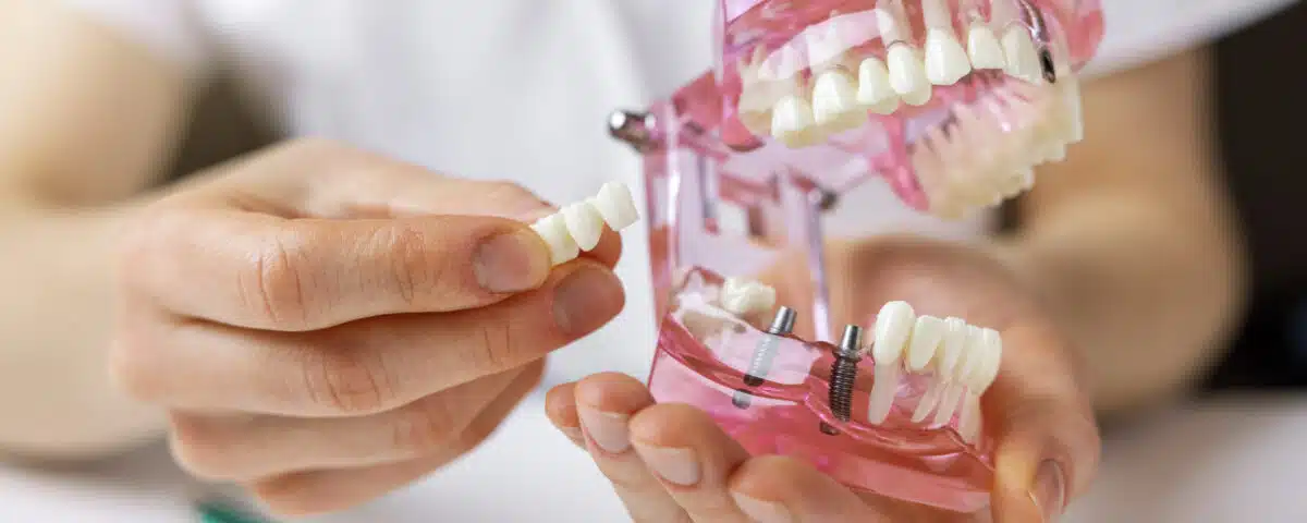 why-replacing-missing-teeth-is-important-for-your-oral-health