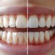 why-teeth-whitening-is-one-of-the-most-popular-cosmetic-procedures
