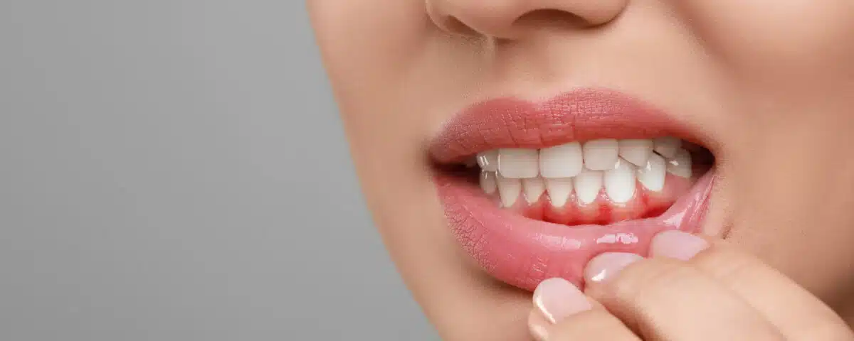 why-your-gums-bleed-when-you-brush
